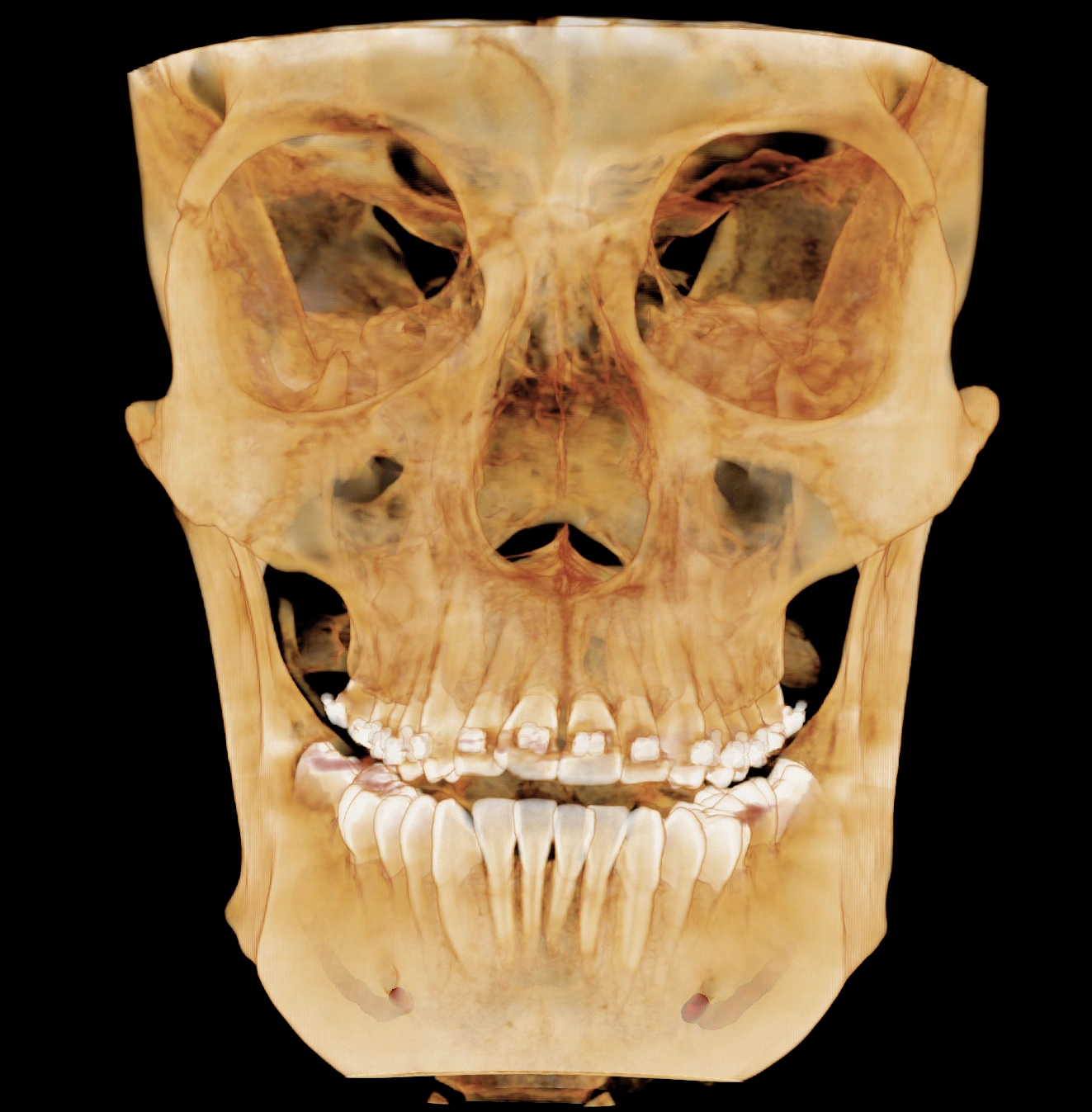 Reconstrucción 3D CBCT de ambos maxilares y las piezas dentales